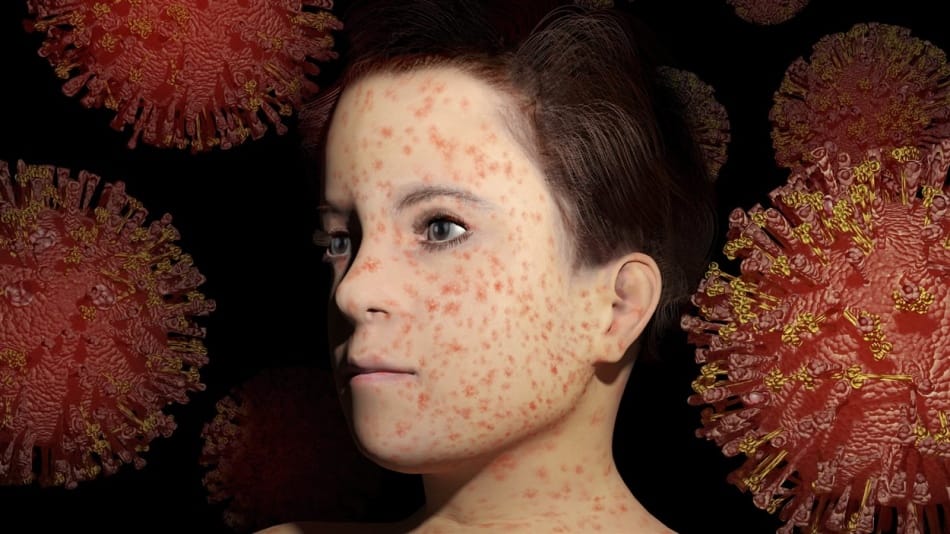 La rougeole est-elle en voie de disparition?